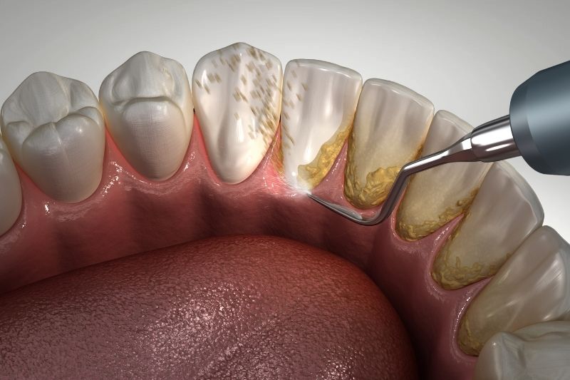 Miért fontos a rendszeres fogkő eltávolítás?